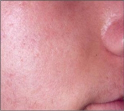 problem-acne-after