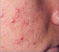 problem-acne-before