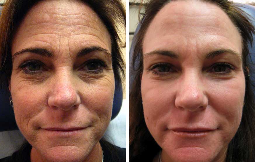 Mixto Laser Resurfacing: Before and After.