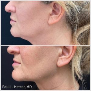 FaceTite before and after jawline tightening results at Be Medispa in Lexington KY