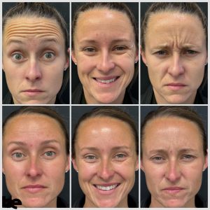 Botox before and after results for forehead lines, crow’s feet, and frown lines at Be Medispa in Lexington KY