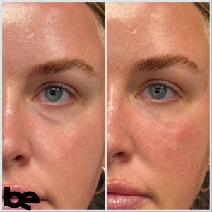 Under-eye filler before and after in Lexington KY